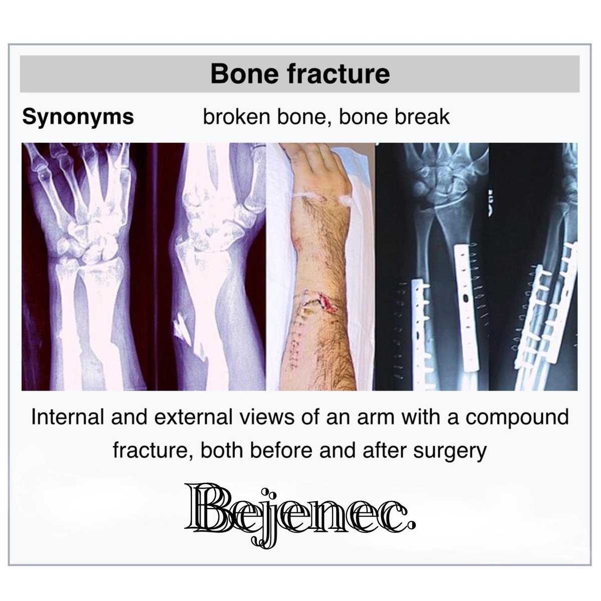A fracture is a broken bone. My leg hurts. bone synonyms.