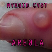 Myxoid Cyst