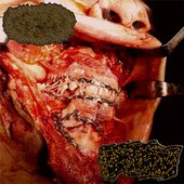 Carnal Agony Suffering From Osteomyelitis In The Coccyx
