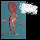 Macerated Stillbirth