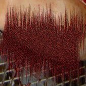 Purulent Pancreatic Gastrinoma Seepage logo