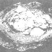 Obstructive Transthoracicesophagectoma.jpg