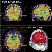 Malnutrition Headache