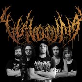 Vulvodynia