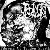 Fibroma Of Tendon Sheath