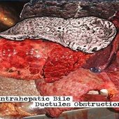 Intrahepatic Bile Ductules Obstruction