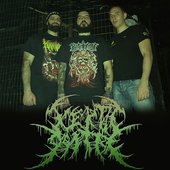 Aceptic Goitre