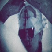 Trepanation 