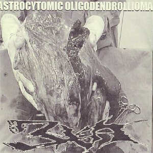 Image for 'Astrocytomic Oligodendrollioma'