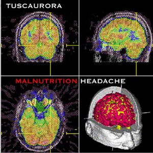 Image for 'Malnutrition Headache'