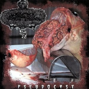 Image for 'Pseudocyst'