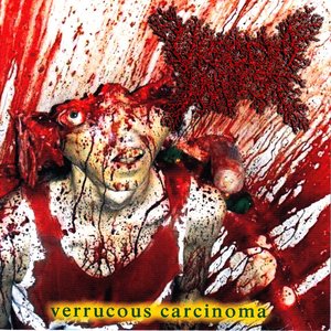 “Verrucous Carcinoma”的封面